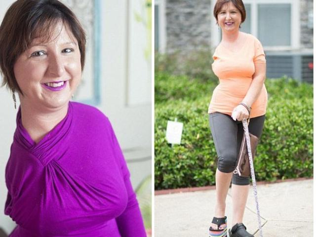 Sức khỏe đời sống - Nghị lực sống phi thường của người mắc bệnh hiếm "hóa thạch"