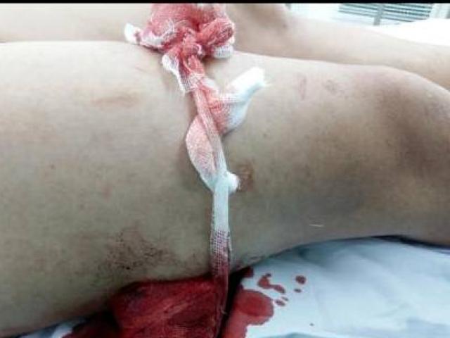 Pháp luật - Đang đi, bị 2 kẻ lạ mặt đâm thấu đùi