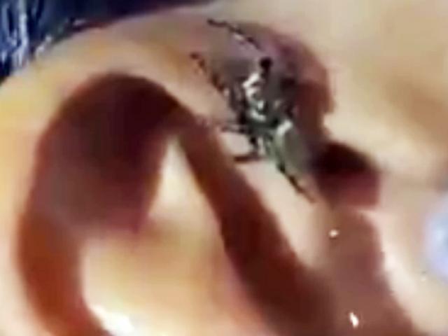 Sức khỏe đời sống - Kinh hoàng xem bác sĩ dụ con nhện từ tai bệnh nhân