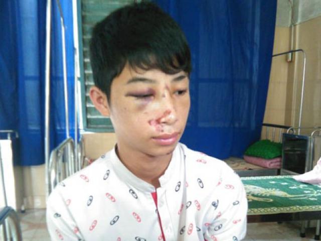 Tin tức trong ngày - CA xã đánh học sinh lớp 10 nhập viện vì nhầm là trộm