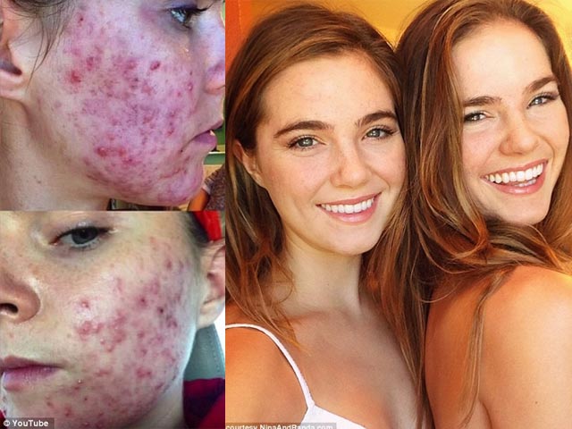 Làm đẹp - Cặp sinh đôi xinh đẹp bày cách trị mụn sau 3 ngày