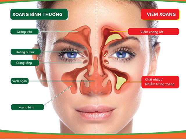 Bác sĩ của bạn - Viêm mũi xoang dị ứng có thể điều trị khỏi