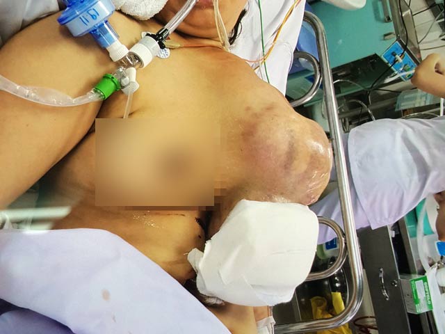 Sức khỏe đời sống - Phẫu thuật cắt khối u khổng lồ “to như quả dưa hấu”