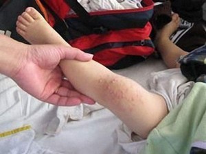 Sức khỏe đời sống - Thực hư &quot;chủng virus sốt xuất huyết mới, ăn cơm thủng ruột&quot;