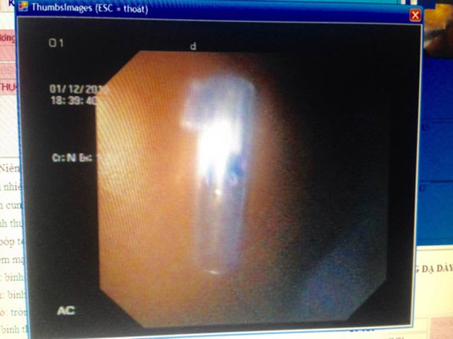 Sức khỏe đời sống - Bé trai nhập viện cấp cứu vì nuốt nắp bút bi