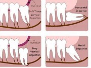 Sức khỏe đời sống - Có nên nhổ răng khôn mọc lệch?