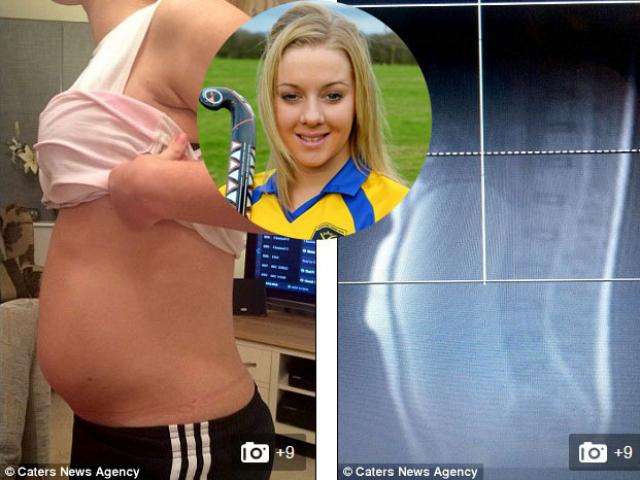 Bạn trẻ - Cuộc sống - Phát hoảng với "bụng bầu" 8 tháng của cô sinh viên