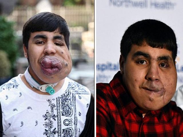 Phi thường - kỳ quặc - Chàng trai sống với khuôn mặt dị dạng đáng sợ suốt 18 năm