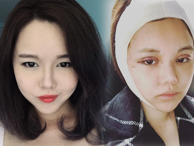 Thẩm mỹ viện - Mỹ nhân Singapore bị la ó vì “dao kéo” sớm sau sinh