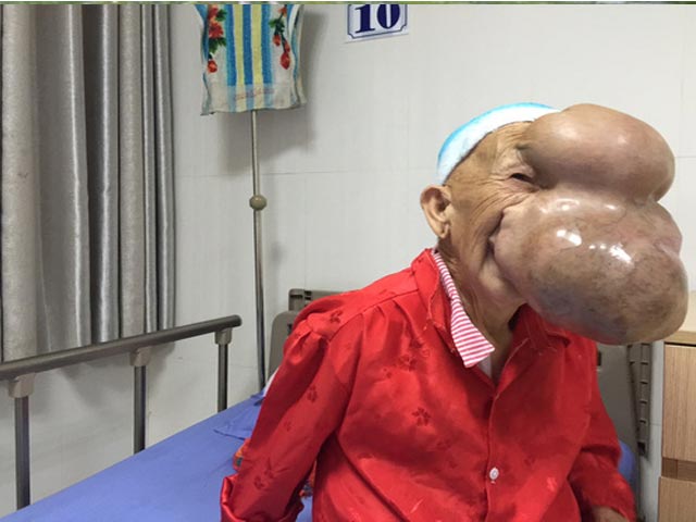 Sức khỏe đời sống - Cắt khối u khổng lồ trên mặt người phụ nữ sau 27 năm