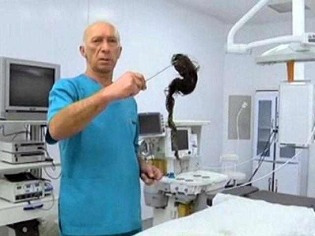 Thế giới - Choáng với búi tóc khổng lồ hơn 1kg trong bụng bé gái