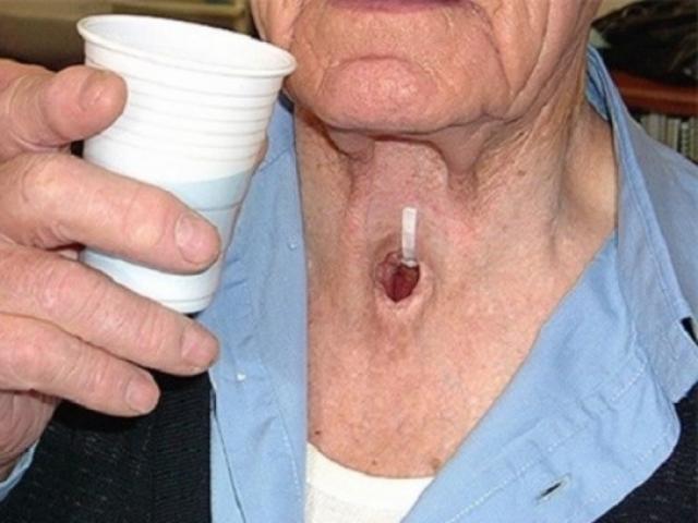 Sức khỏe đời sống - Vì sao người Việt khó tránh khỏi bệnh ung thư?