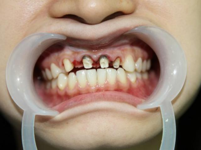 Đừng coi thường những đau nhức răng thoáng qua