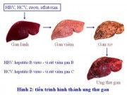 Sức khỏe đời sống - GS Nguyễn Chấn Hùng: Điểm mặt những bệnh ung thư đến từ virus, từ miệng