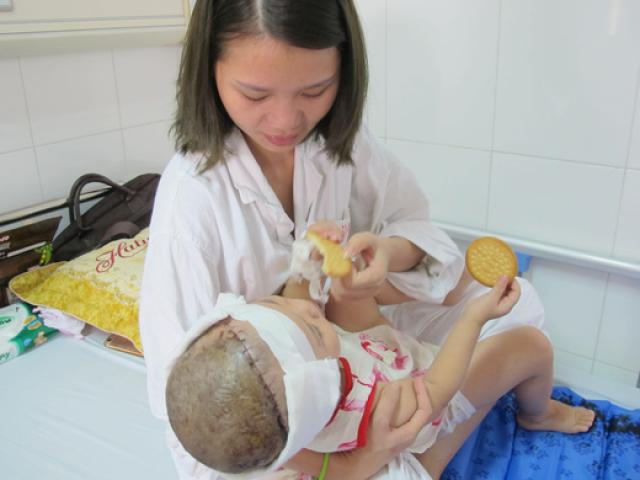 Sức khỏe đời sống - Bé gái 2 tuổi bị lột toàn bộ da đầu vì tai nạn giao thông