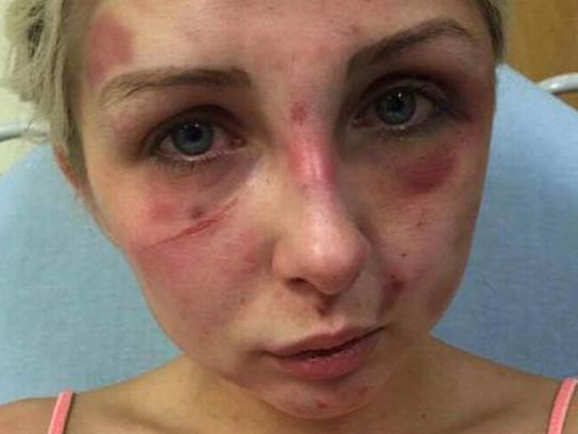Cô gái bị đánh tím mặt vì phản đối bạn trai hút thuốc