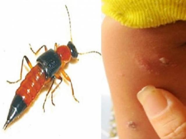 Sức khỏe đời sống - Bi hài quý ông suýt hỏng của quý vì trị độc bằng nọc kiến