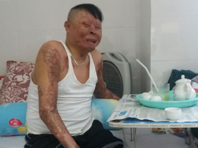 Tin tức trong ngày - Chiến sĩ duy nhất còn sống sau vụ rơi máy bay ở Hòa Lạc sắp ra viện