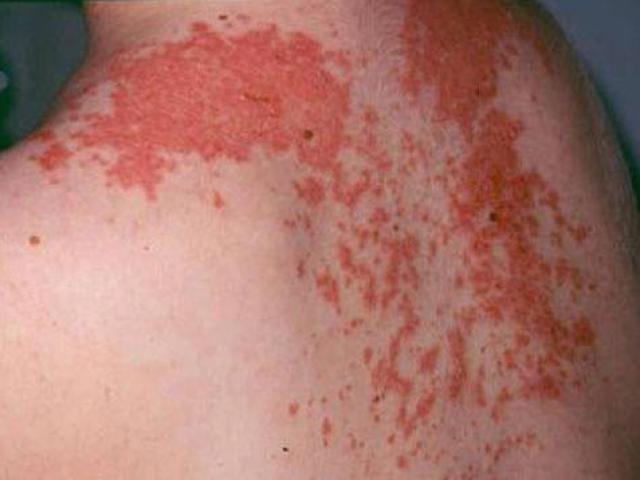 Sức khỏe đời sống - Cách phân biệt vết zona thần kinh, "giời leo" và kiến 3 khoang cắn