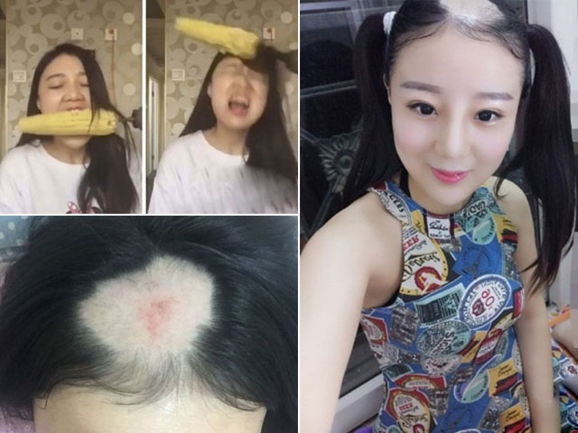 Bạn trẻ - Cuộc sống - Gặp lại cô gái bay cả da đầu vì ăn ngô bằng máy khoan