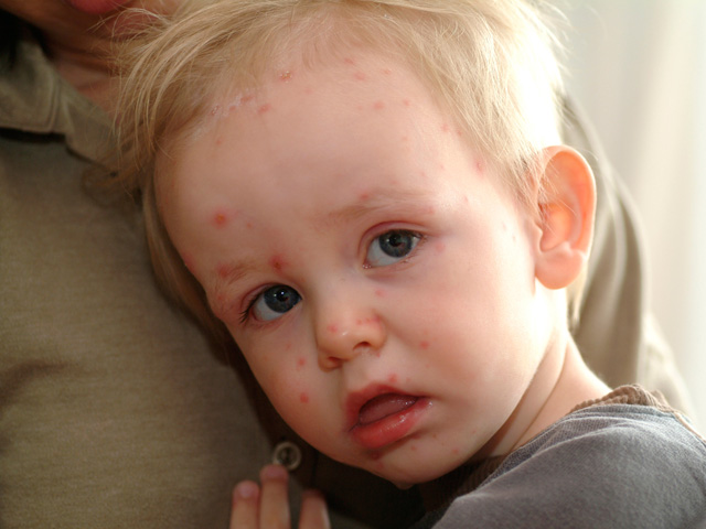 Tin tức sức khỏe - Bí quyết chữa nhanh bệnh tay chân miệng cho bé 18 tháng