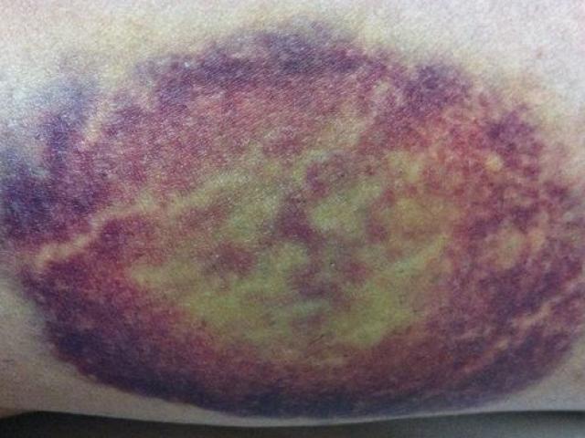 Sức khỏe đời sống - Cảnh giác với nốt bầm tím trên cơ thể: Có thể là dấu hiệu bệnh nguy hiểm