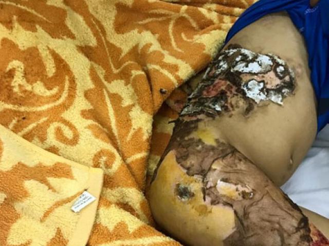 Sức khỏe đời sống - Hà Nội: Bé trai 4 tuổi hoại tử da vì đắp lá thầy lang chữa bỏng