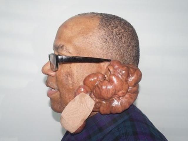 Phi thường - kỳ quặc - Đi cắt tóc bị thương, sẹo cứ to mãi không ngừng