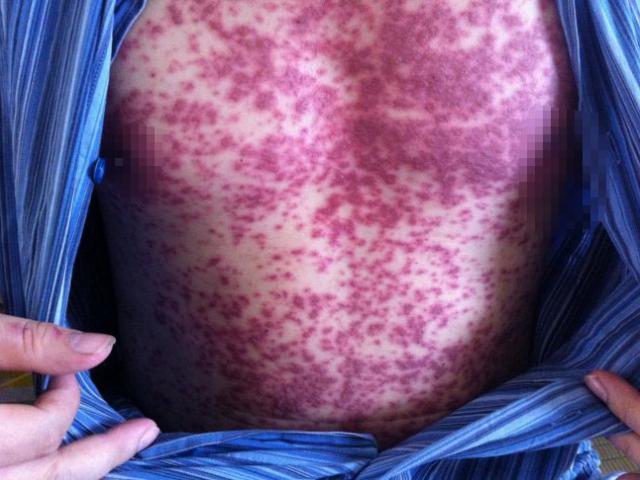 Sức khỏe đời sống - Lở loét toàn thân, hoại tử da ở bộ phận sinh dục vì tự ý dùng thuốc