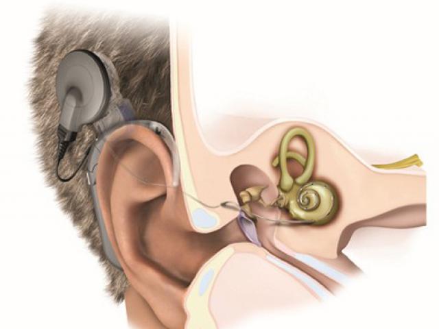 Thoát cảnh câm, điếc nhờ ốc tai điện tử