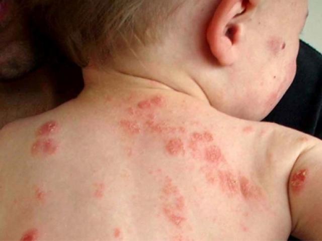 Sức khỏe đời sống - Vì sao mùa đông trẻ nhỏ, người lớn bị ngứa gãi đến chảy máu?