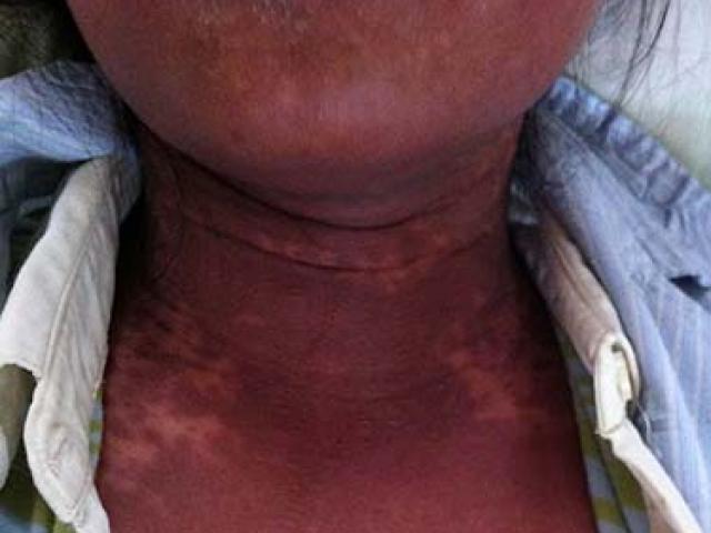 Sức khỏe đời sống - Dị ứng thuốc ngày càng đáng sợ!