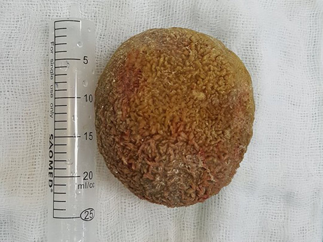 Sức khỏe đời sống - Giật mình với viên sỏi nửa cân trong bàng quang bệnh nhân