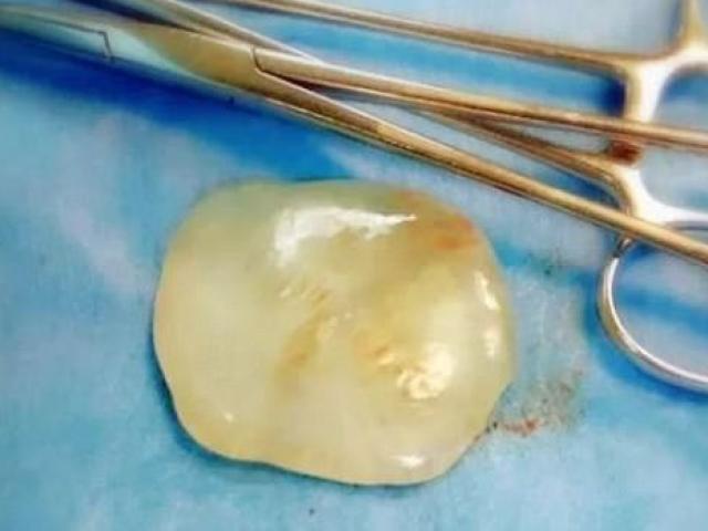 Phi thường - kỳ quặc - Mẹ đang sinh con, có viên "đá quý" trong bụng chui ra