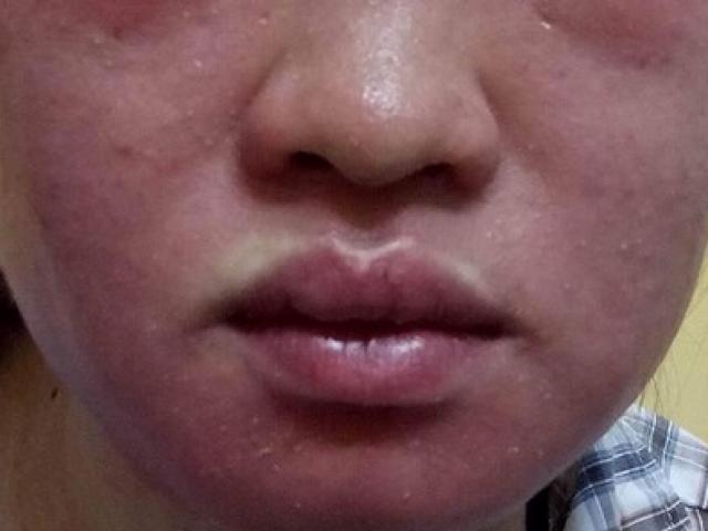 Sức khỏe đời sống - Mặt “biến dạng” vì thần dược siêu trắng da