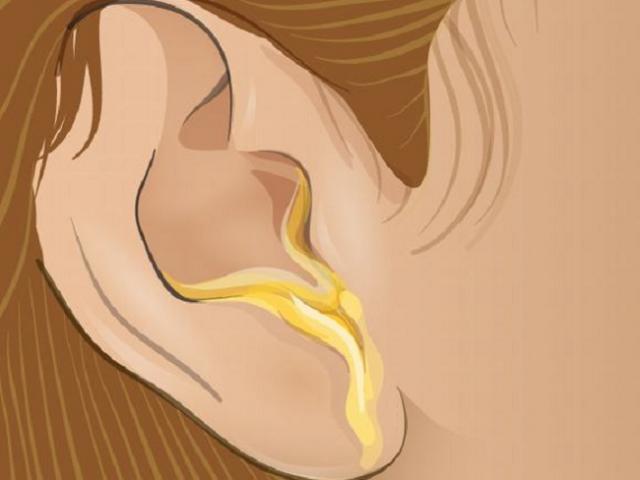 Sức khỏe đời sống - Màu sắc ráy tai tiết lộ chính xác vấn đề sức khỏe của bạn