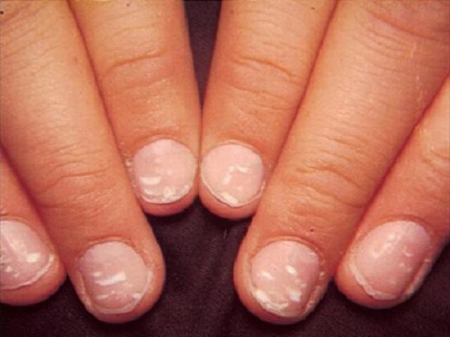 Sức khỏe đời sống - Đốm trắng trên móng tay "tố" bệnh gì?