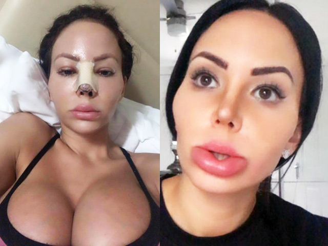 Bí quyết làm đẹp - Cô gái Anh biến dạng mặt, sưng vù môi sau khi chi 6,5 tỷ đồng cho dao kéo