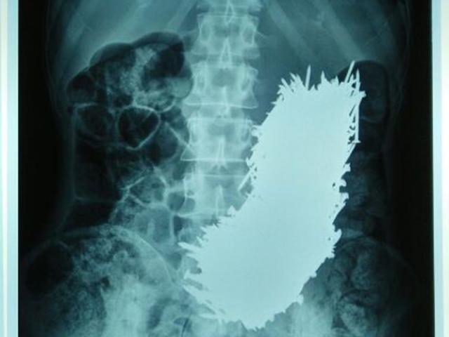 Sức khỏe đời sống - Kinh hoàng dùng nam châm hút 600 đinh sắt trong bụng người đàn ông