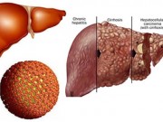 Sức khỏe đời sống - Viêm gan B có gây xơ gan?