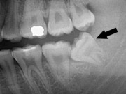 Sức khỏe đời sống - Thai phụ bị đình chỉ thai kỳ vi răng khôn mọc lêch gây áp xe nặng