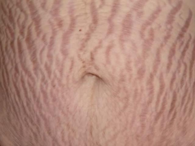 Sức khỏe đời sống - Xót xa hình ảnh rạn da sau sinh của bà mẹ trẻ