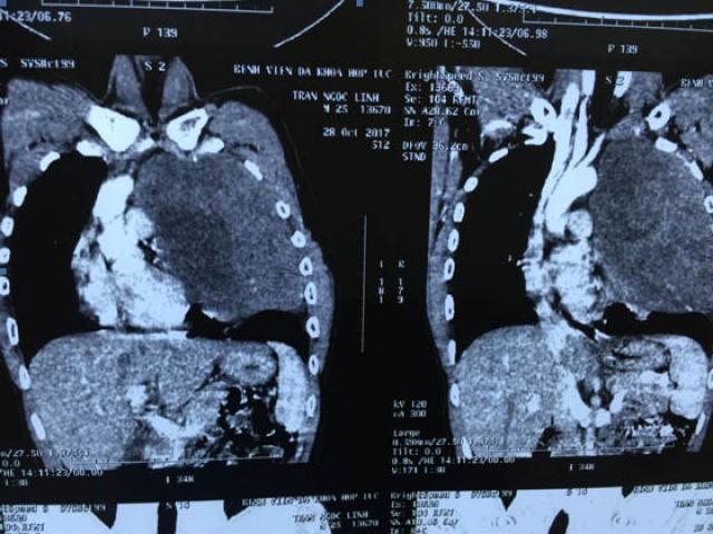 Sức khỏe đời sống - Ho khan, tức ngực tá hỏa phát hiện khối khủng ở lồng ngực