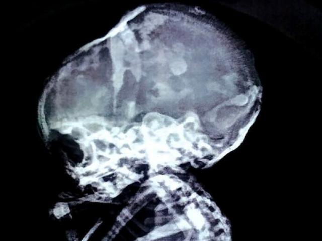 Phi thường - kỳ quặc - Tá hỏa phát hiện em bé "hóa đá" ở trong bụng mẹ suốt 15 năm