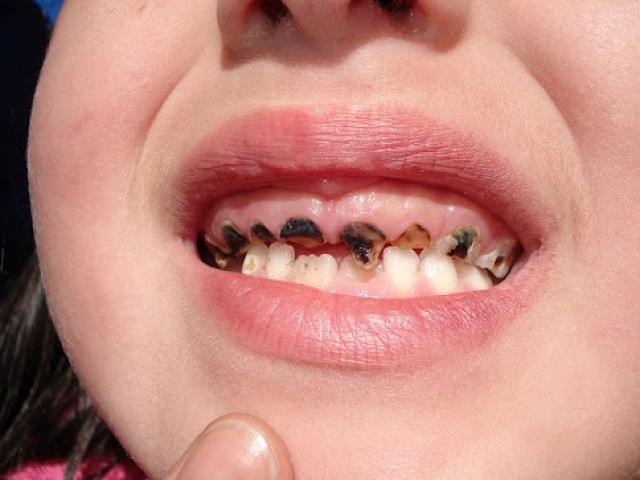 Sâu răng ở trẻ em có thể gây hậu quả đáng tiếc