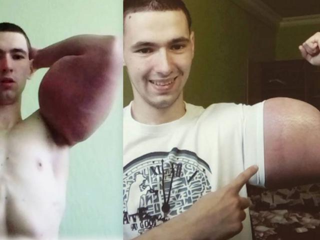 Hot boy Nga sắp mất 2 bắp tay khổng lồ vì tiêm dầu ăn, rượu vào người