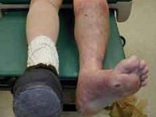 Sức khỏe đời sống - Suýt mất chân vì “bài chữa lạ” của lang vườn