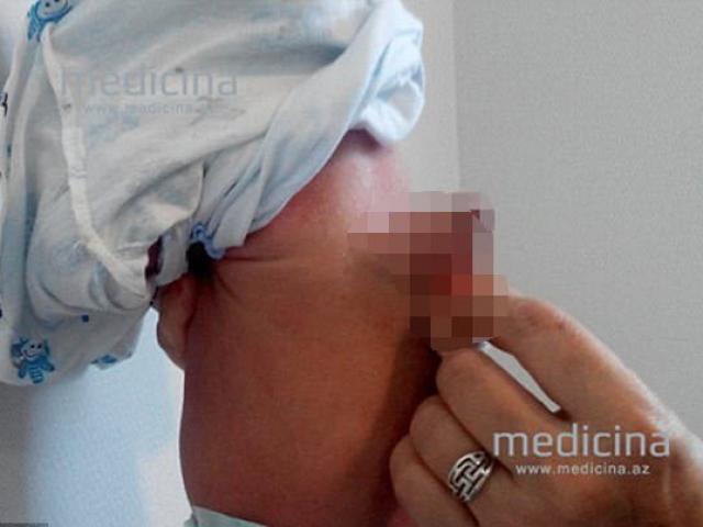 Phi thường - kỳ quặc - Cậu bé có thêm một "của quý" trên lưng