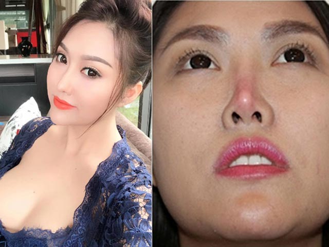 Bí quyết làm đẹp - Tiêm chất làm đầy, "dao kéo" sửa mặt gây hậu quả khôn lường