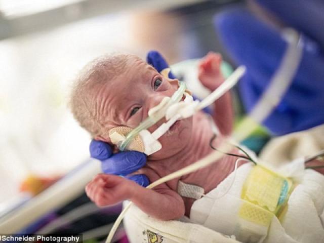 Sức khỏe đời sống - Bị sinh non trước 4 tháng, bé gái nhỏ như lon Coca